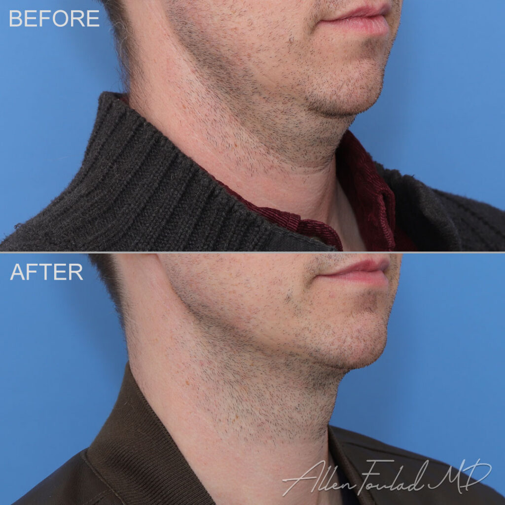 Before and after MIDS Neck Lift™, on male patient.